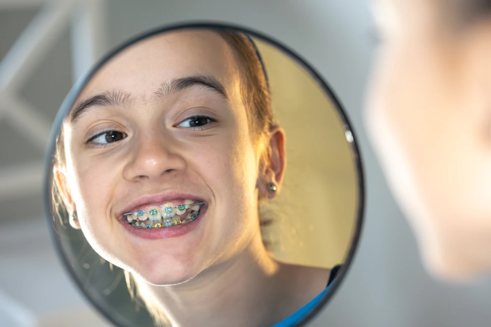 braces for teeth