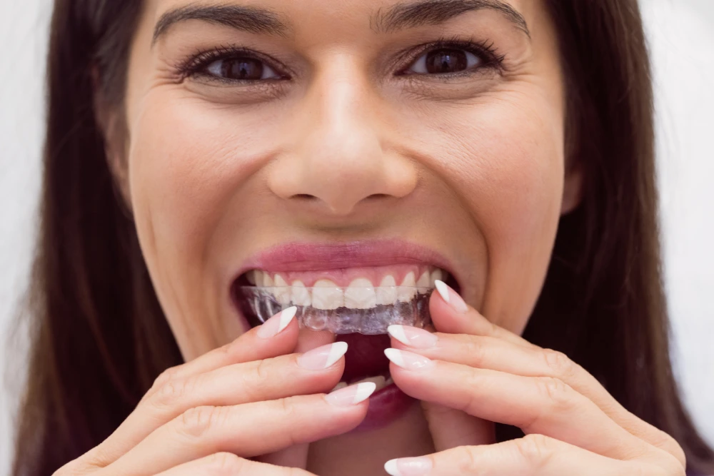invisible braces