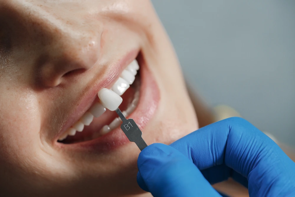 cosmetic teeth veneers